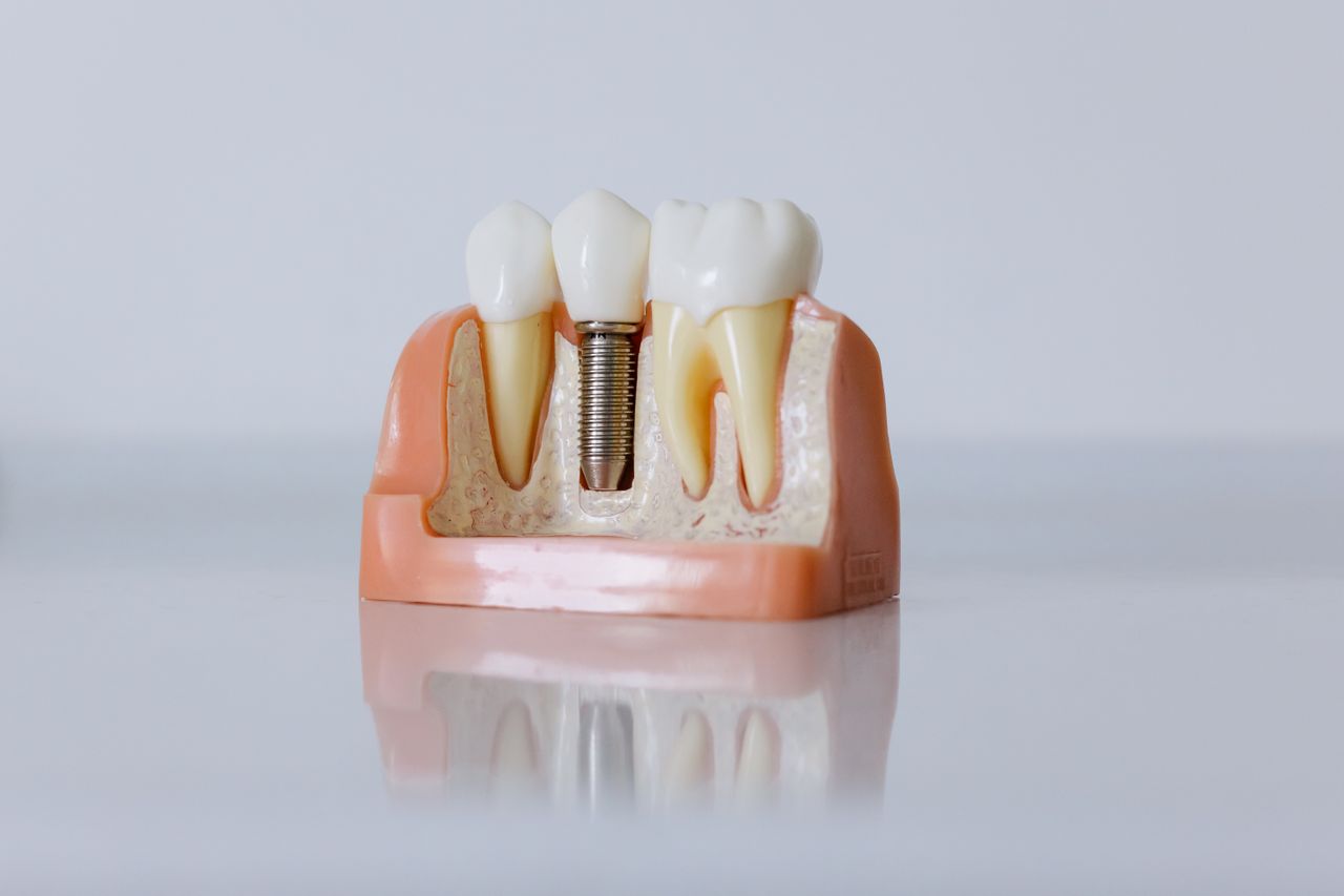 Why Winter is the Best Time for Implant Healing in Ontario?