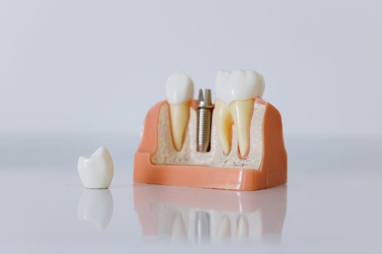 The 2026 Toronto Dental Implant Price Guide