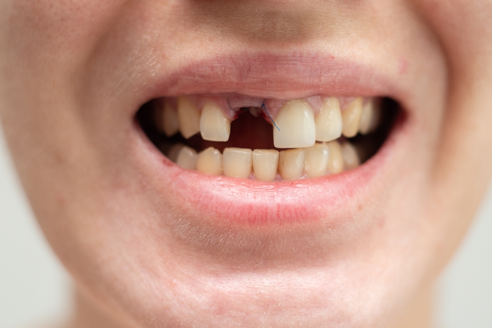 Why Our Dentist on Bloor Recommends Dental Implants for Missing Teeth?