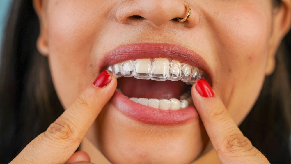 Can Adults Get Invisalign?