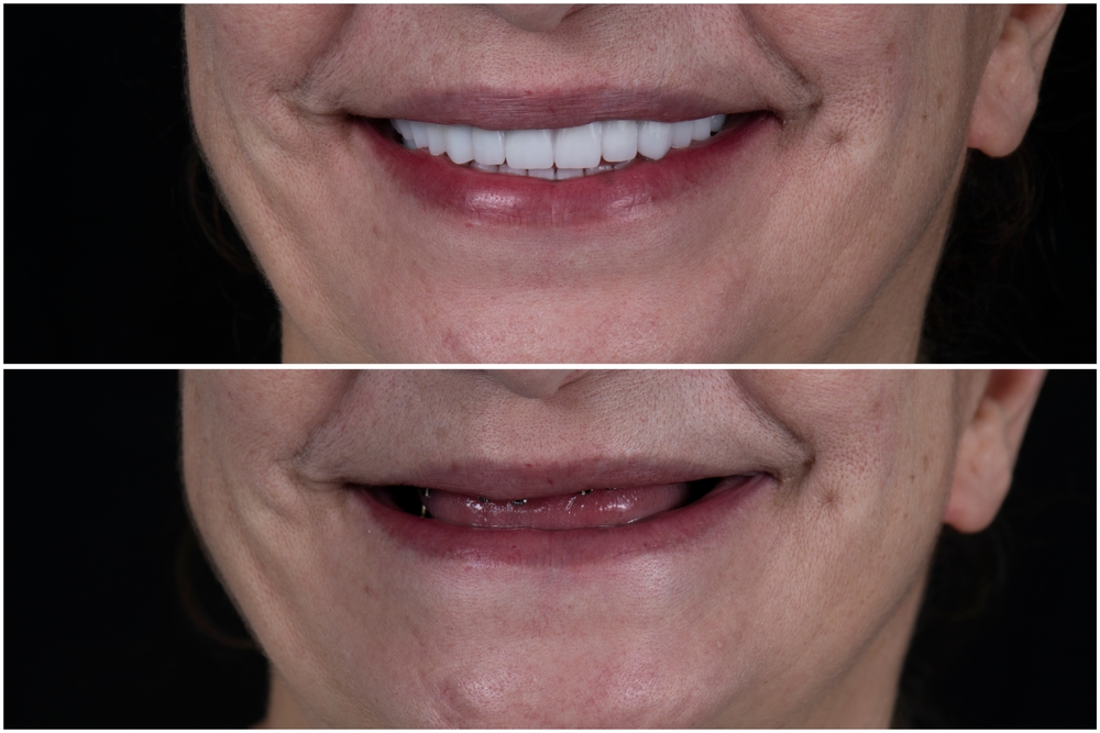 How Long Before Tooth Loss Alters Your Facial Structure?